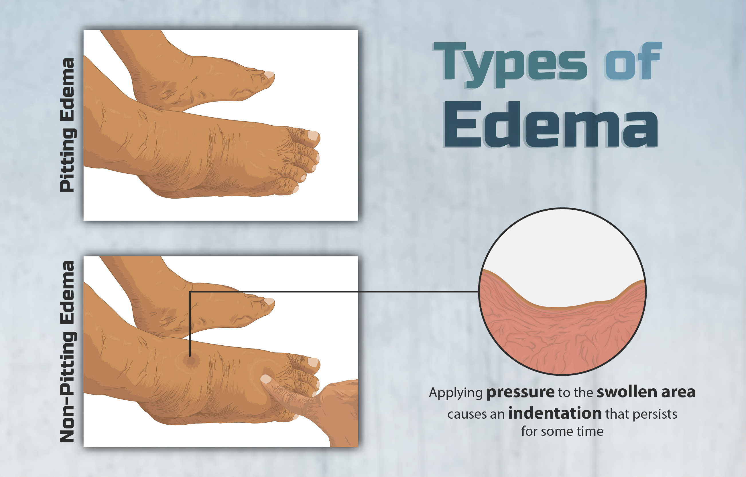 Tropical Edema Cure? This Might Shock You! - c6sr24e